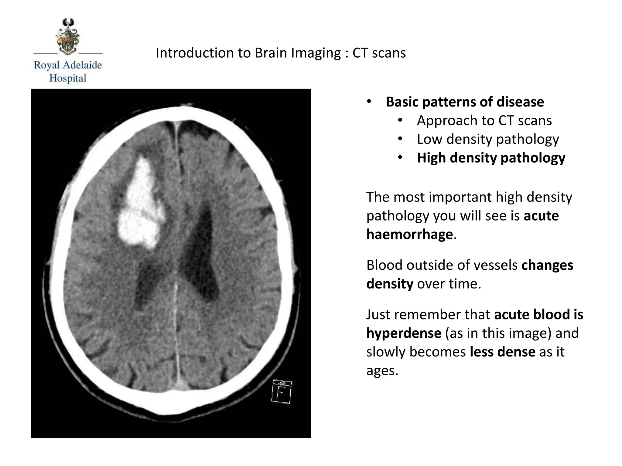 Introduction to Brain Imaging : CT scans
The most important high density
pathology you will see is acute
haemorrhage.
Blood outside of vessels changes
density over time.
Just remember that acute blood is
hyperdense (as in this image) and
slowly becomes less dense as it
ages.
• Basic patterns of disease
• Approach to CT scans
• Low density pathology
• High density pathology
 