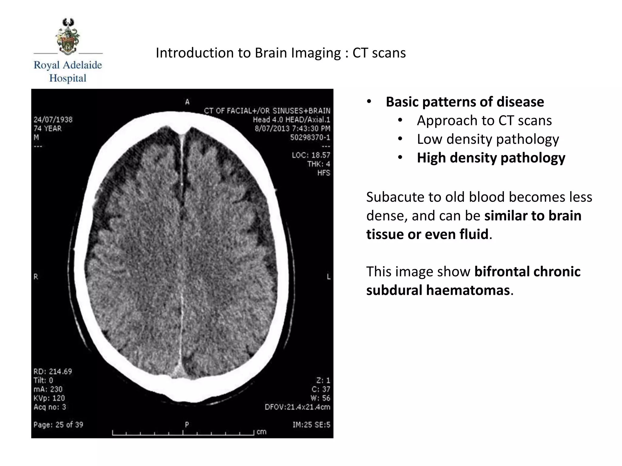 Introduction to Brain Imaging : CT scans
Subacute to old blood becomes less
dense, and can be similar to brain
tissue or even fluid.
This image show bifrontal chronic
subdural haematomas.
• Basic patterns of disease
• Approach to CT scans
• Low density pathology
• High density pathology
 