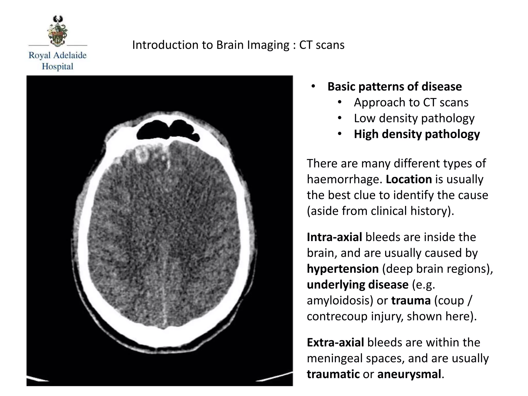 Introduction to Brain Imaging : CT scans
There are many different types of
haemorrhage. Location is usually
the best clue to identify the cause
(aside from clinical history).
Intra-axial bleeds are inside the
brain, and are usually caused by
hypertension (deep brain regions),
underlying disease (e.g.
amyloidosis) or trauma (coup /
contrecoup injury, shown here).
Extra-axial bleeds are within the
meningeal spaces, and are usually
traumatic or aneurysmal.
• Basic patterns of disease
• Approach to CT scans
• Low density pathology
• High density pathology
 