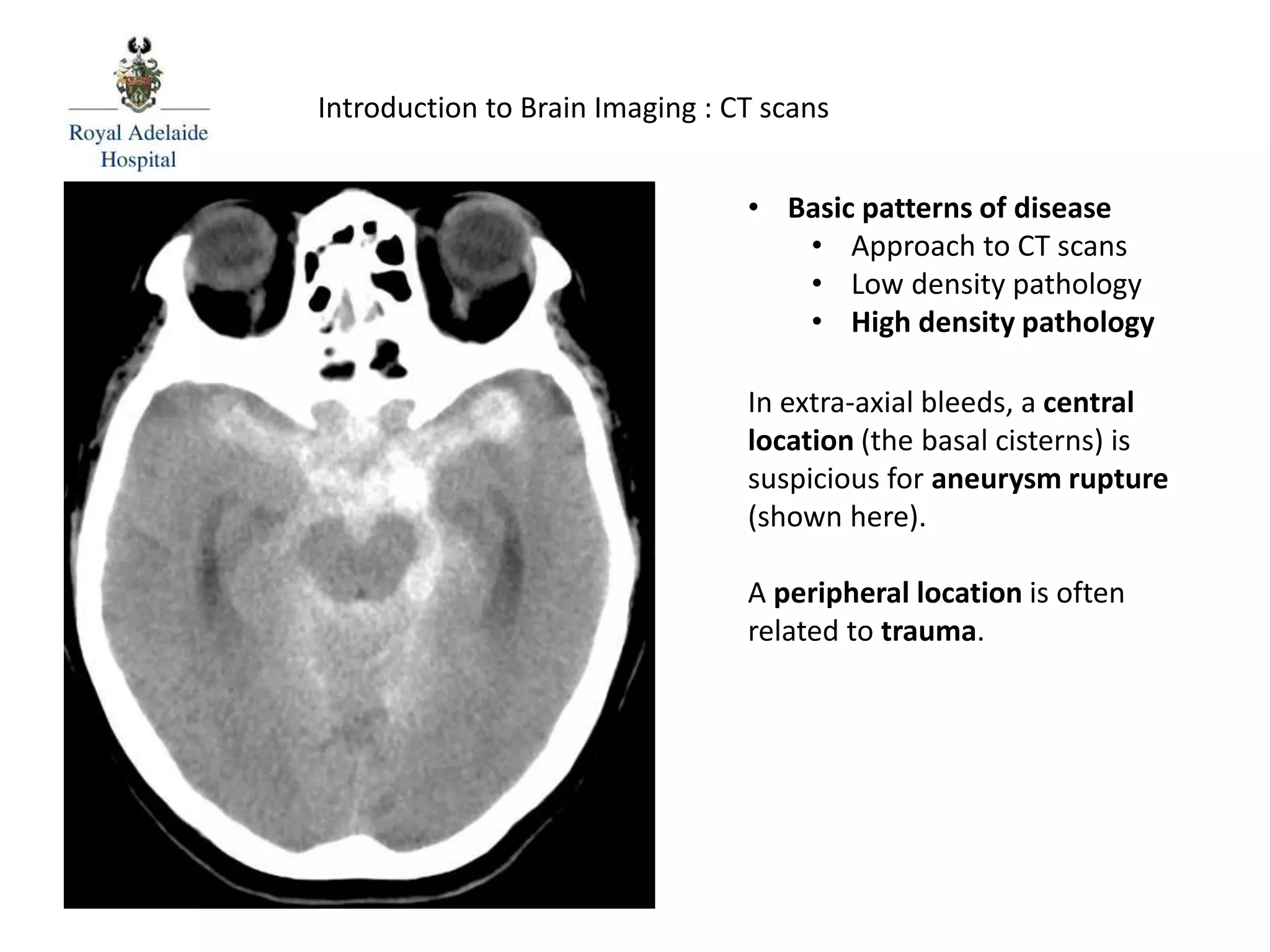 Introduction to Brain Imaging : CT scans
In extra-axial bleeds, a central
location (the basal cisterns) is
suspicious for aneurysm rupture
(shown here).
A peripheral location is often
related to trauma.
• Basic patterns of disease
• Approach to CT scans
• Low density pathology
• High density pathology
 