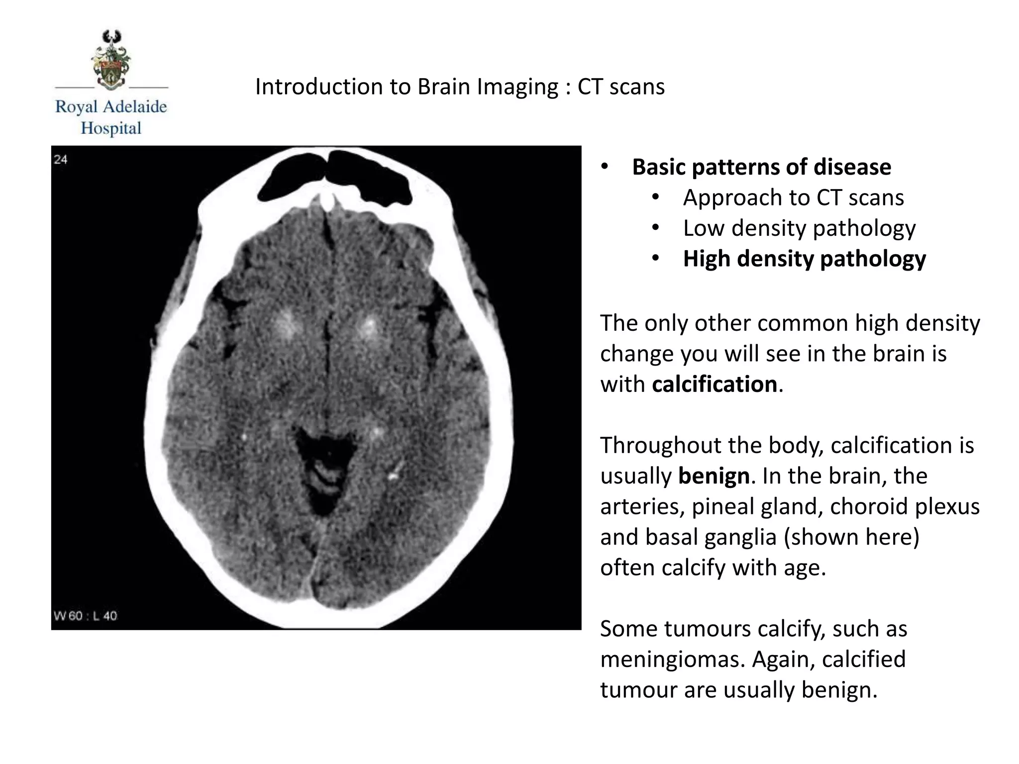 Introduction to Brain Imaging : CT scans
The only other common high density
change you will see in the brain is
with calcification.
Throughout the body, calcification is
usually benign. In the brain, the
arteries, pineal gland, choroid plexus
and basal ganglia (shown here)
often calcify with age.
Some tumours calcify, such as
meningiomas. Again, calcified
tumour are usually benign.
• Basic patterns of disease
• Approach to CT scans
• Low density pathology
• High density pathology
 