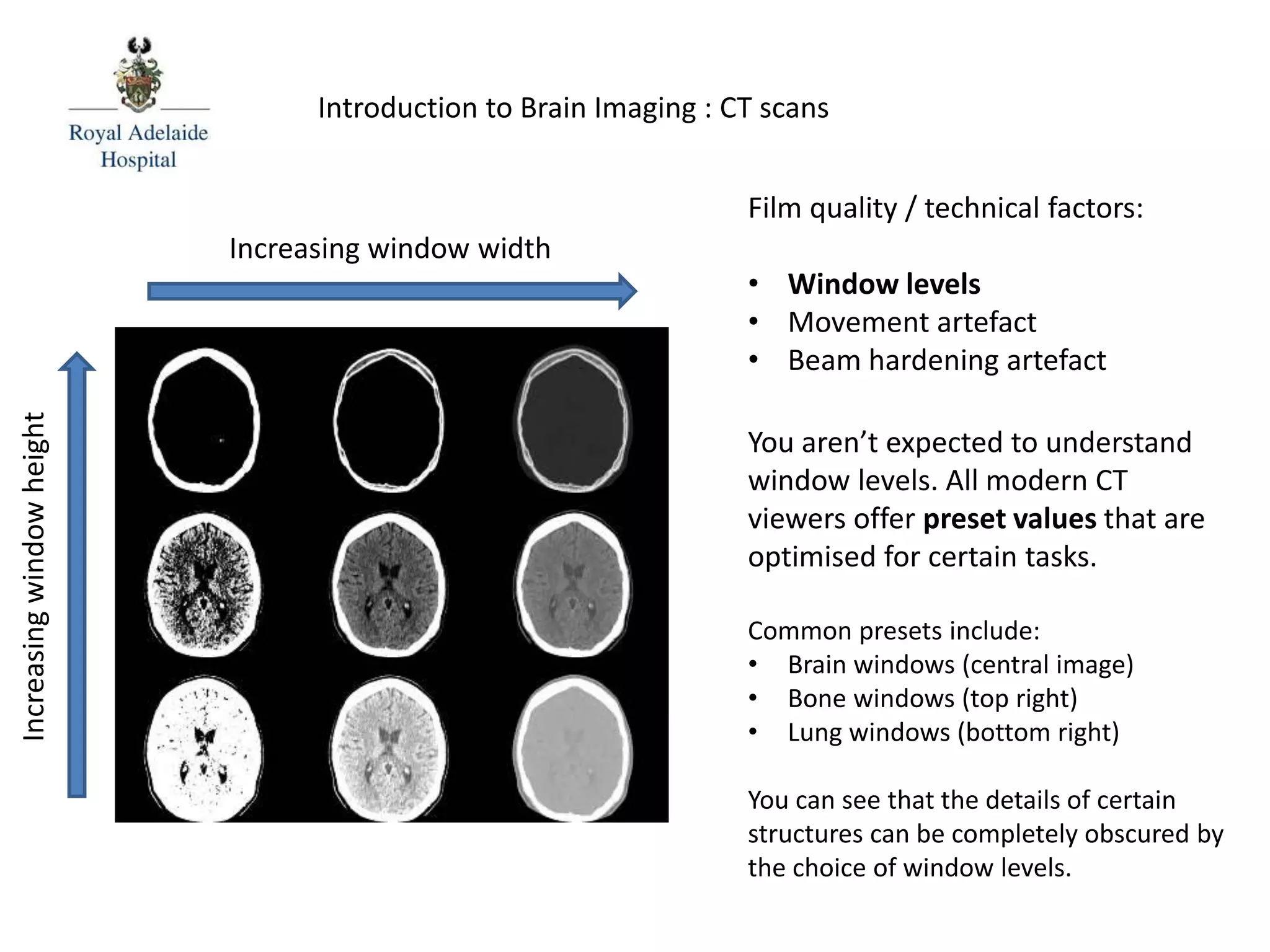 Film quality / technical factors:
• Window levels
• Movement artefact
• Beam hardening artefact
You aren’t expected to understand
window levels. All modern CT
viewers offer preset values that are
optimised for certain tasks.
Common presets include:
• Brain windows (central image)
• Bone windows (top right)
• Lung windows (bottom right)
You can see that the details of certain
structures can be completely obscured by
the choice of window levels.
Introduction to Brain Imaging : CT scans
Increasing window width
Increasingwindowheight
 