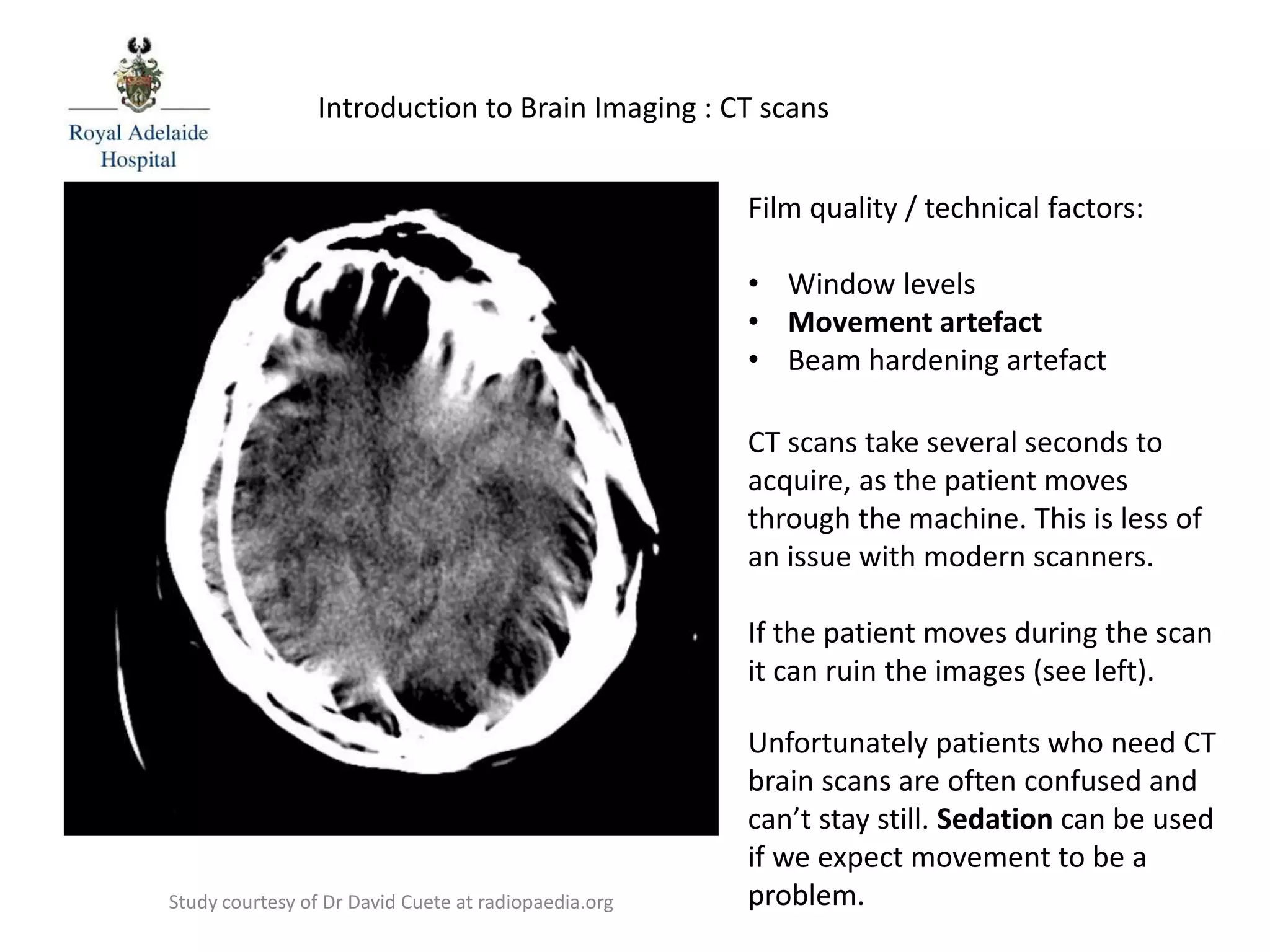 Film quality / technical factors:
• Window levels
• Movement artefact
• Beam hardening artefact
CT scans take several seconds to
acquire, as the patient moves
through the machine. This is less of
an issue with modern scanners.
If the patient moves during the scan
it can ruin the images (see left).
Unfortunately patients who need CT
brain scans are often confused and
can’t stay still. Sedation can be used
if we expect movement to be a
problem.
Introduction to Brain Imaging : CT scans
Study courtesy of Dr David Cuete at radiopaedia.org
 