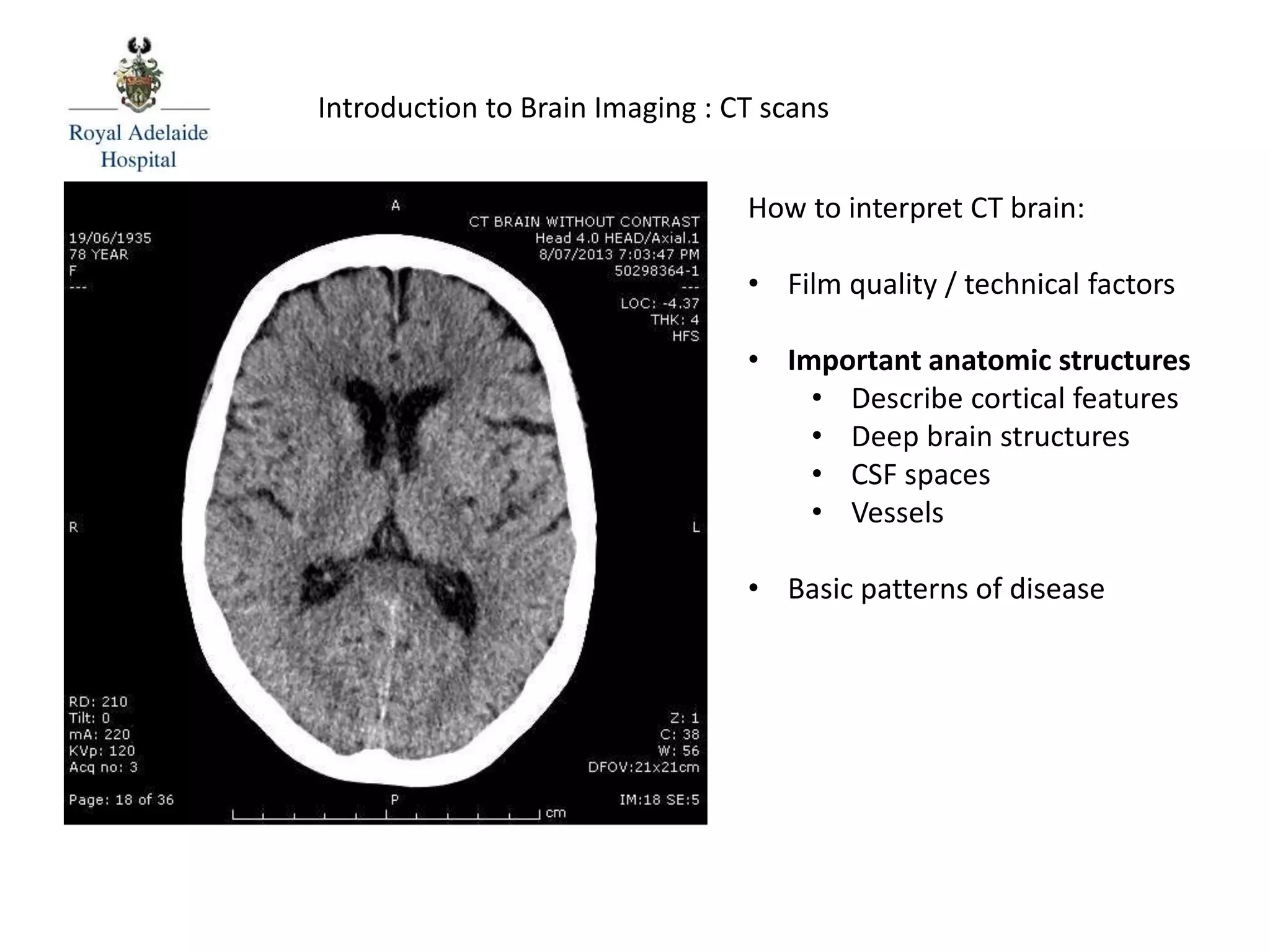 How to interpret CT brain:
• Film quality / technical factors
• Important anatomic structures
• Describe cortical features
• Deep brain structures
• CSF spaces
• Vessels
• Basic patterns of disease
Introduction to Brain Imaging : CT scans
 