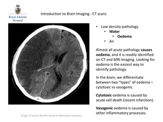 RAH Med 4 MHU Brain CT 1 PPTX rah-med-4-mhu-brain-ct-1-pptx