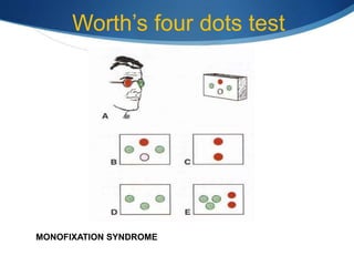 Worth’s four dots test
MONOFIXATION SYNDROME
 