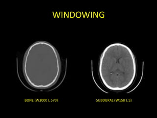 WINDOWING




BONE (W3000 L 570)   SUBDURAL (W150 L 5)
 
