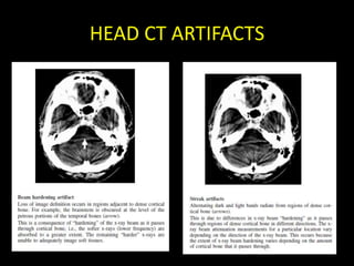 HEAD CT ARTIFACTS
 
