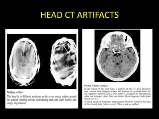 HEAD CT ARTIFACTS
 