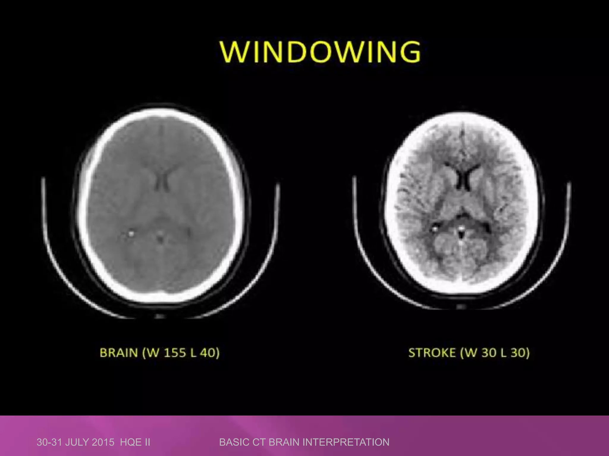30-31 JULY 2015 HQE II BASIC CT BRAIN INTERPRETATION
 