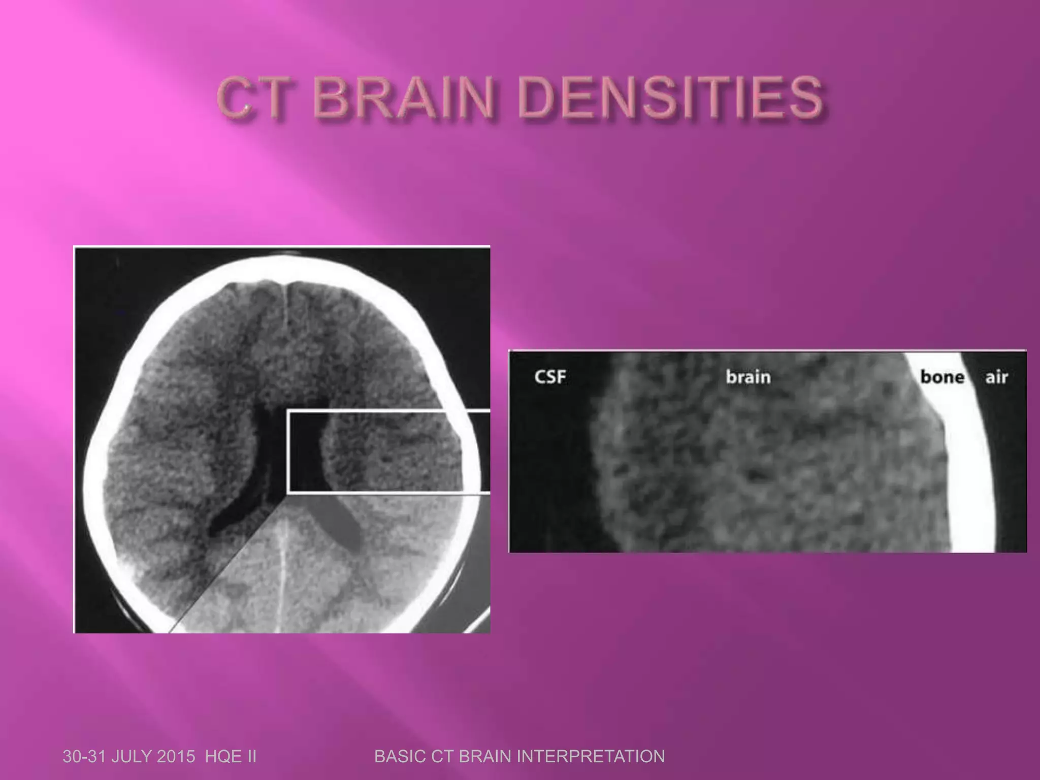 30-31 JULY 2015 HQE II BASIC CT BRAIN INTERPRETATION
 