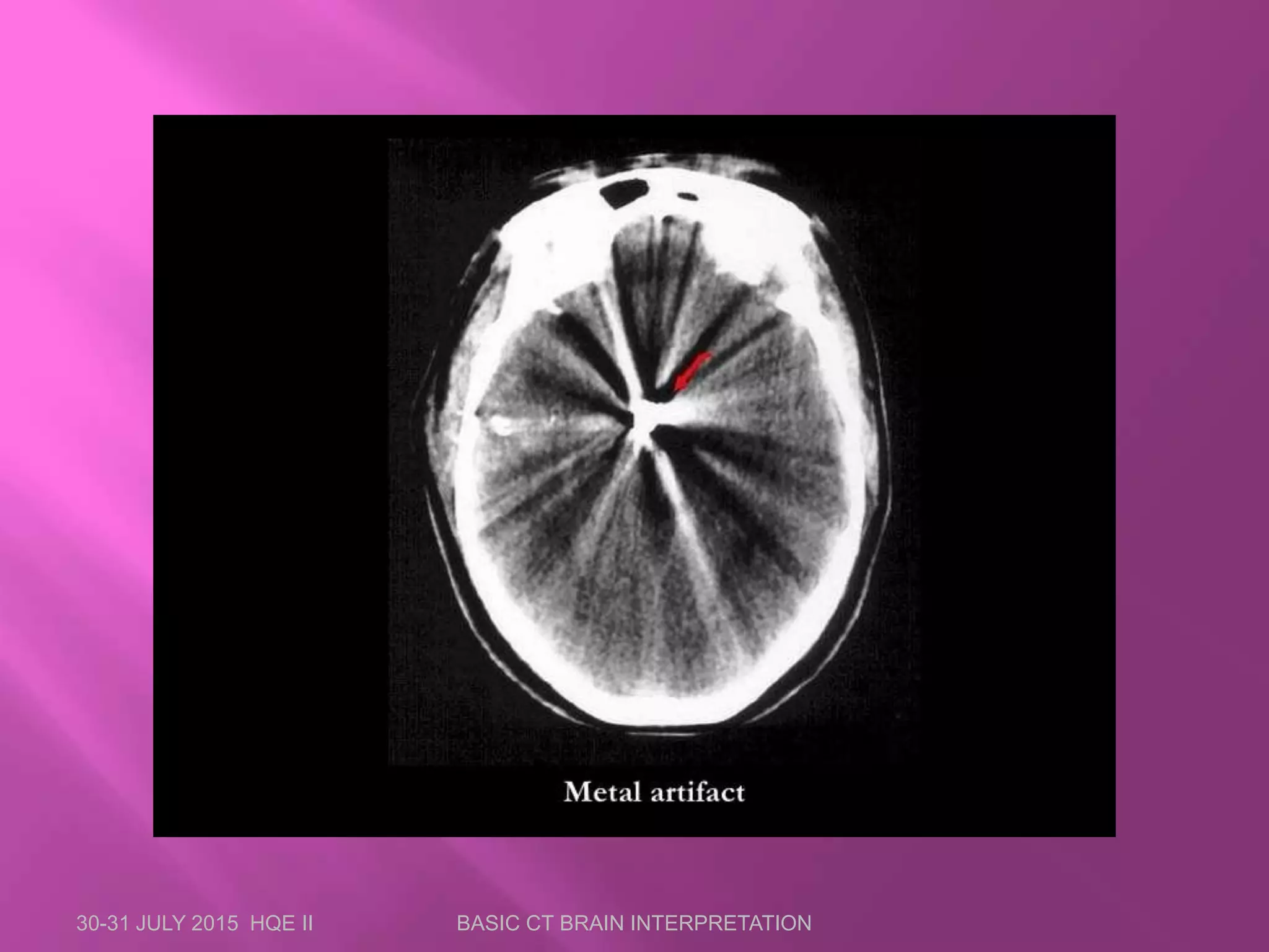 30-31 JULY 2015 HQE II BASIC CT BRAIN INTERPRETATION
 