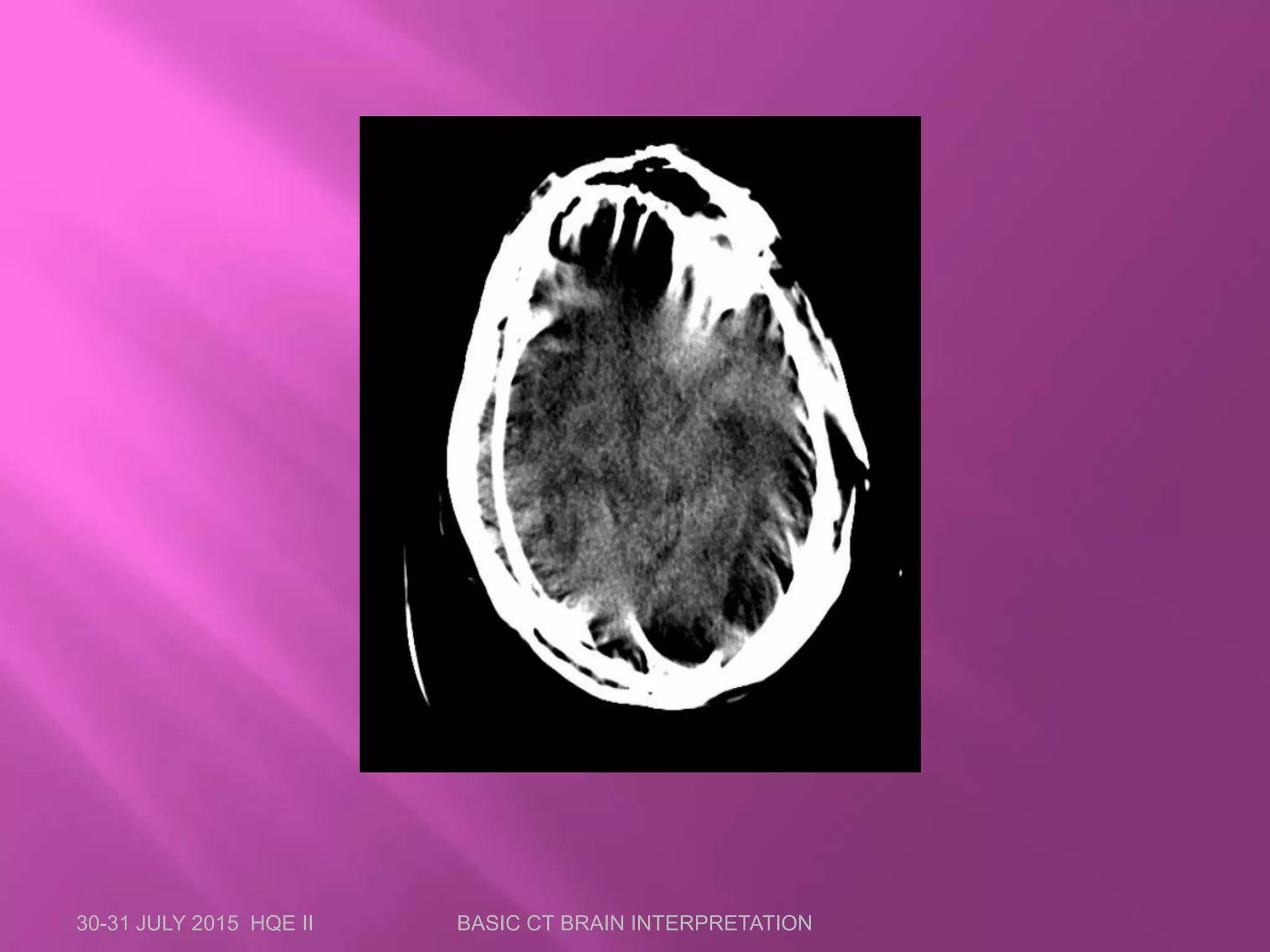 30-31 JULY 2015 HQE II BASIC CT BRAIN INTERPRETATION
 