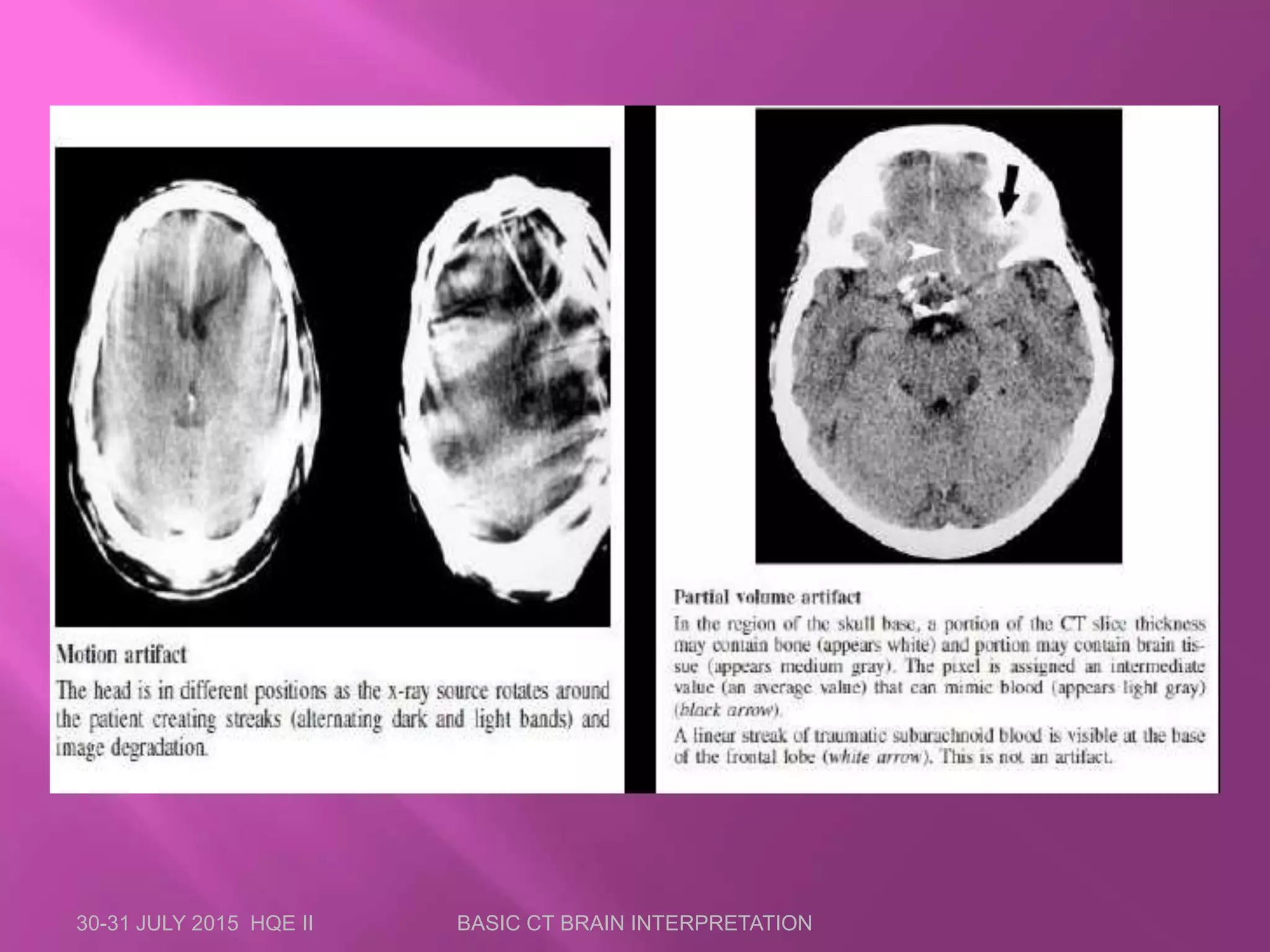 30-31 JULY 2015 HQE II BASIC CT BRAIN INTERPRETATION
 