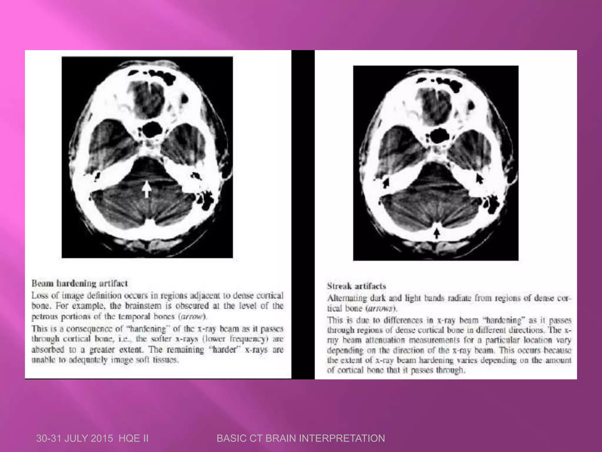 30-31 JULY 2015 HQE II BASIC CT BRAIN INTERPRETATION
 