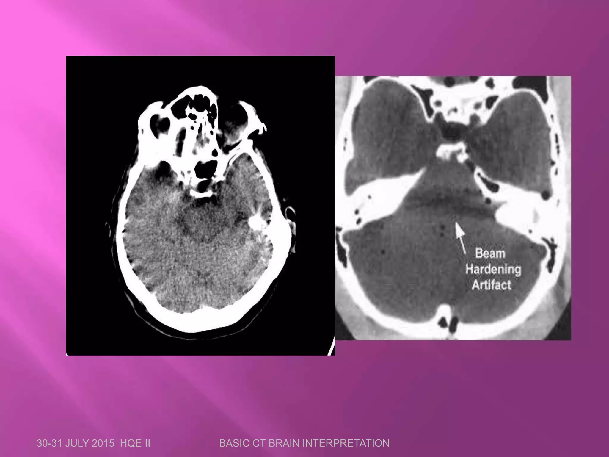 30-31 JULY 2015 HQE II BASIC CT BRAIN INTERPRETATION
 