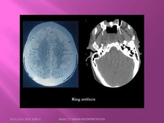 Ct Brain Collimation Introduction to CT Brain: The Basic Principles | PPTX