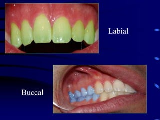 Labial Normal Introduction to Dental Anatomy.ppt