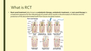 What is RCT
• Root canal treatment (also known as endodontic therapy, endodontic treatment, or root canal therapy) is
a treatment sequence for the infected pulp of a tooth which results in the elimination of infection and the
protection of the decontaminated tooth from future microbial invasion
 