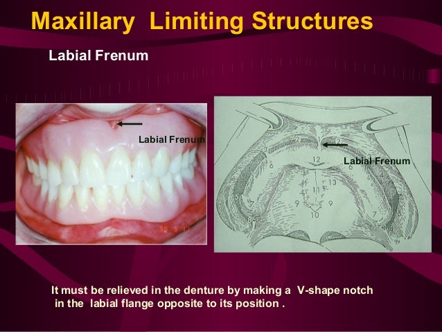 introduction to prosthodontics hamular notch
