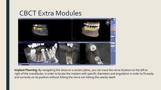 CBCT Extra Modules
Implant Planning: By navigating the slices on a certain plane, you can trace the nerve location on the left or
right of the mandibular, in order to locate the implant with specific diameters and angulation in order to fit easily
and correctly on its position without hitting the nerve nor hitting the nearby teeth
 