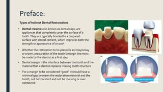 Preface:
Types of Indirect Dental Restorations
• Dental crowns: also known as dental caps, are
appliances that completely cover the surface of a
tooth.They are typically bonded to a prepared
surface with dental cement, which improves both the
strength or appearance of a tooth
• Whether the restoration to be placed is an inlay/onlay
or crown, preparation of the tooth’s margin line must
be made by the dentist as a first step
• Dental margin is the interface between the tooth and the
material that a dentist replaces missing tooth structure
• For a margin to be considered “good” it should have a
minimal gap between the restorative material and the
tooth, not be too short and not be too long or over
contoured
 