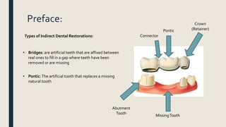 Preface:
• Bridges: are artificial teeth that are affixed between
real ones to fill in a gap where teeth have been
removed or are missing
Pontic
Abutment
Tooth
MissingTooth
Crown
(Retainer)
• Pontic:The artificial tooth that replaces a missing
natural tooth
ConnectorTypes of Indirect Dental Restorations:
 