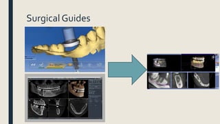 Surgical Guides
 