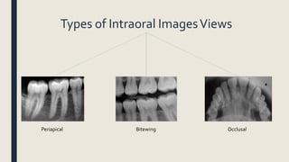 Types of Intraoral ImagesViews
Periapical Bitewing Occlusal
 