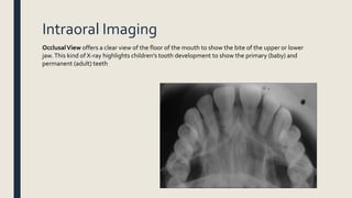 Intraoral Imaging
OcclusalView offers a clear view of the floor of the mouth to show the bite of the upper or lower
jaw.This kind of X-ray highlights children’s tooth development to show the primary (baby) and
permanent (adult) teeth
 