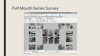 Full Mouth Series Survey
 