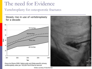 The need for Evidence
Vertebroplasty for osteoporotic fractures
Gray et al Spine 2008. Nation-wide and State-specific primary
vertebroplasty rates per 100,000 Part B fee-for-service
Steady rise in use of vertebroplasty
for a decade
2009: two large trials publish
showing no effect over placebo
Slides courtesy R Buchbinder
 