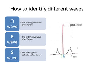How to identify different waves
Q
wave
R
wave
S
wave

• The first negative wave
after P wave

• The first Positive wave
after P wave

• The first negative
deflection after R wave

 