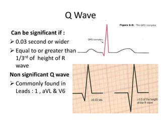 Q Wave
Can be significant if :
 0.03 second or wider
 Equal to or greater than
1/3rd of height of R
wave
Non significant Q wave
 Commonly found in
Leads : 1 , aVL & V6

 
