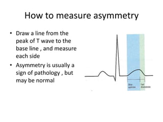 How to measure asymmetry
• Draw a line from the
peak of T wave to the
base line , and measure
each side
• Asymmetry is usually a
sign of pathology , but
may be normal

 