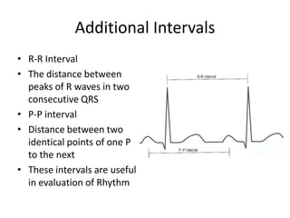 Additional Intervals
• R-R Interval
• The distance between
peaks of R waves in two
consecutive QRS
• P-P interval
• Distance between two
identical points of one P
to the next
• These intervals are useful
in evaluation of Rhythm

 