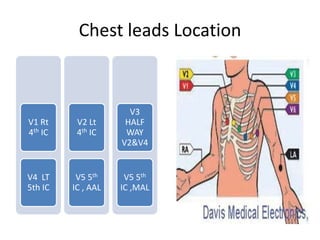 Chest leads Location

V1 Rt
4th IC

V2 Lt
4th IC

V3
HALF
WAY
V2&V4

V4 LT
5th IC

V5 5th
IC , AAL

V5 5th
IC ,MAL

 