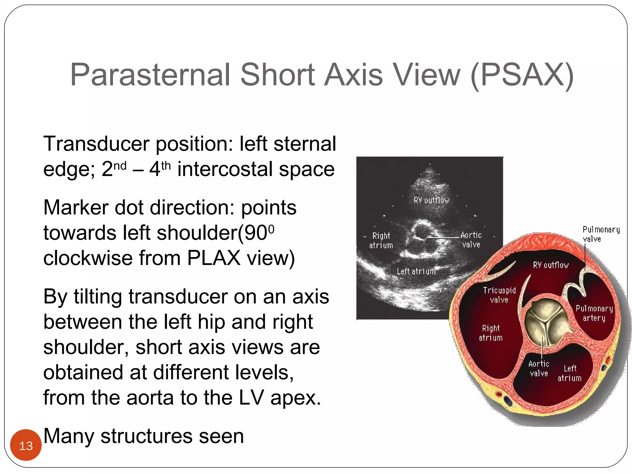 Parasternal Short Axis View (PSAX) 
13 
Transducer position: left sternal 
edge; 2nd – 4th intercostal space 
Marker dot direction: points 
towards left shoulder(900 
clockwise from PLAX view) 
By tilting transducer on an axis 
between the left hip and right 
shoulder, short axis views are 
obtained at different levels, 
from the aorta to the LV apex. 
Many structures seen 
 