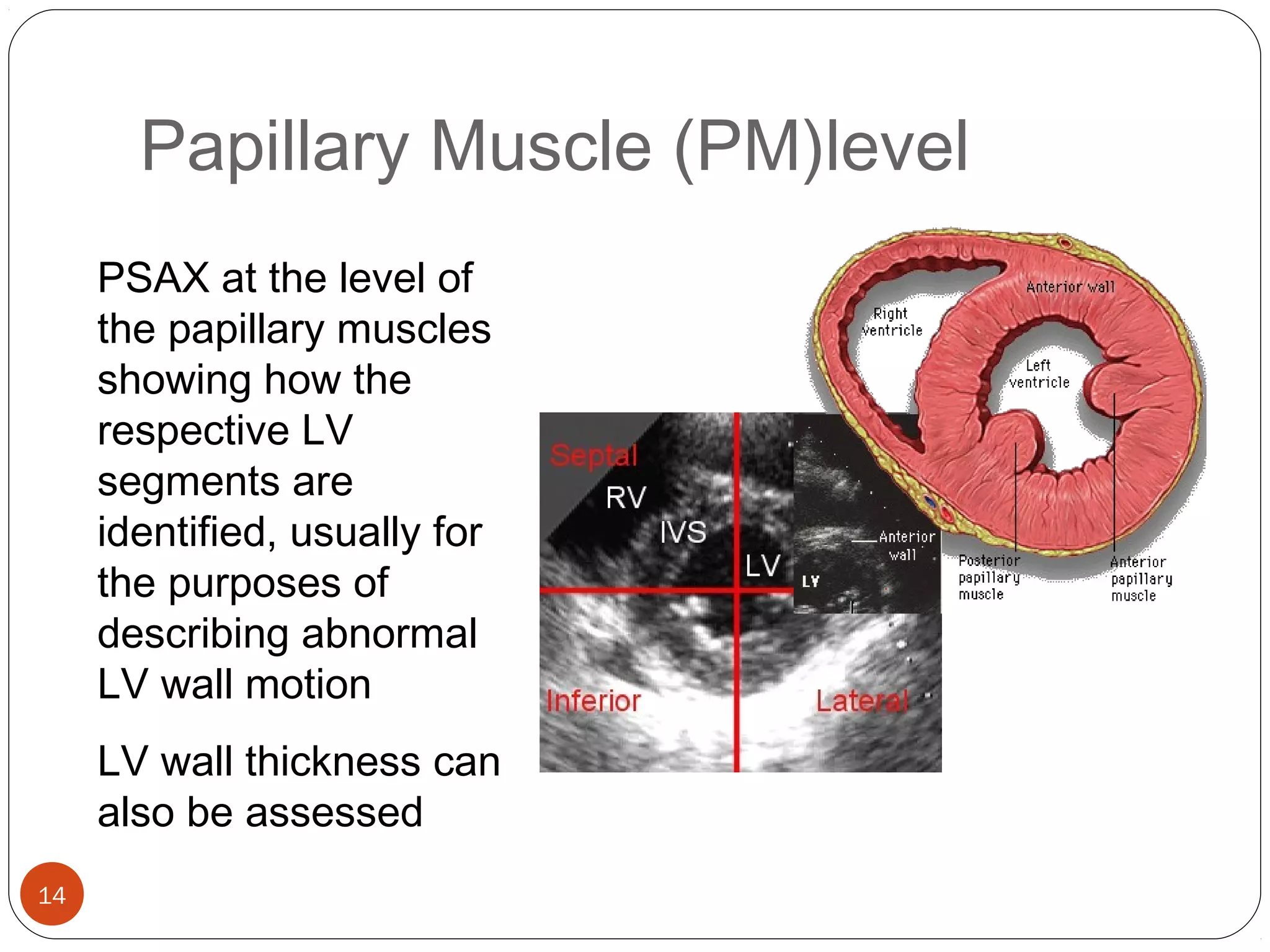 Papillary Muscle (PM)level 
14 
PSAX at the level of 
the papillary muscles 
showing how the 
respective LV 
segments are 
identified, usually for 
the purposes of 
describing abnormal 
LV wall motion 
LV wall thickness can 
also be assessed 
 