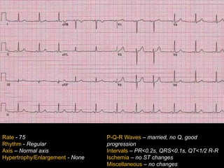 Introduction to EKG Interpretation | PPTX