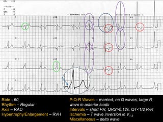 Introduction to EKG Interpretation | PPTX