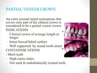PARTIALVENEER CROWN
An extra coronal metal restorations that
covers only part of the clinical crown is
considered to be a partial veneer crown.
INDICATIONS
- Clinical crown of average length or
longer
- Intact buccal/labial surface
- Well supported by sound tooth structure
CONTAINDICATIONS
- Short teeth
- High caries index
- Not used in endodontically treated teeth.
 
