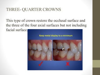 THREE- QUARTER CROWNS
This type of crown restore the occlusal surface and
the three of the four axial surfaces but not including
facial surface.
 