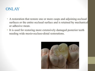 ONLAY
• A restoration that restore one or more cusps and adjoining occlusal
surfaces or the entire occlusal surface and is retained by mechanical
or adhesive mean.
• It is used for restoring more extensively damaged posterior teeth
needing wide mesio-occluso-distal restorations.
 
