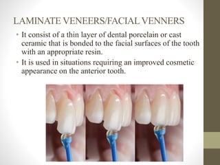 LAMINATE VENEERS/FACIALVENNERS
• It consist of a thin layer of dental porcelain or cast
ceramic that is bonded to the facial surfaces of the tooth
with an appropriate resin.
• It is used in situations requiring an improved cosmetic
appearance on the anterior tooth.
 