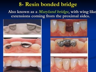 Introduction to fixed prosthodontics | PPT