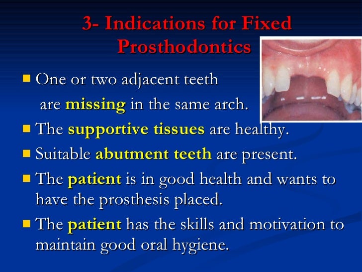 Introduction to fixed prosthodontics