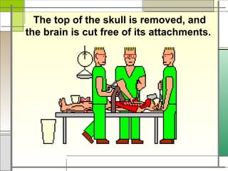 The top of the skull is removed, and
the brain is cut free of its attachments.
 