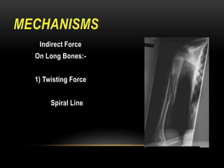 Fractures | PDF