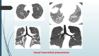 Interstitial lung disease, Idiopathic pulmonary fibrosis | PPTX